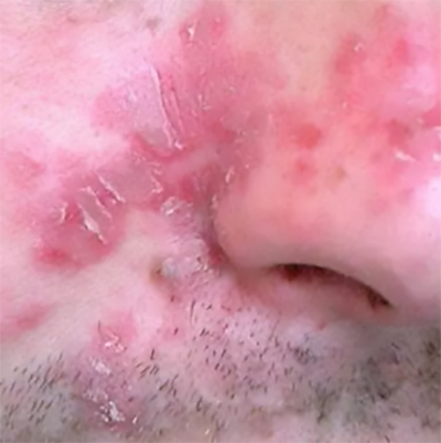 Dermatite Seborroica