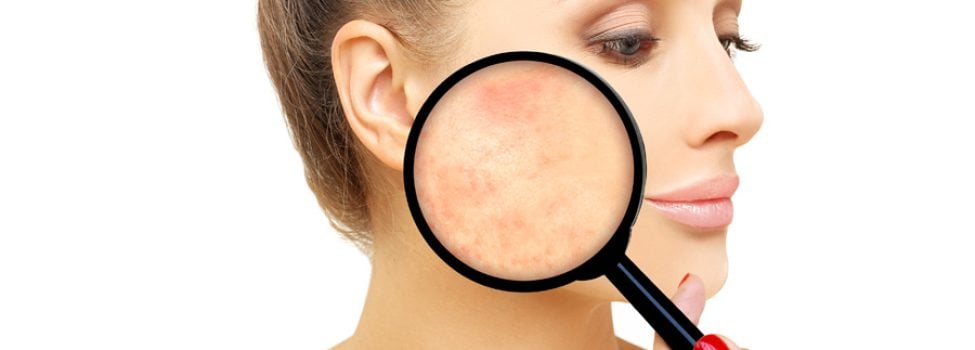 rosacea